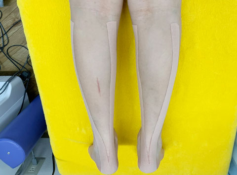 キネシオテーピング